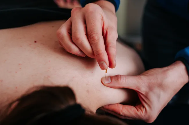 Dry Needling Den Bosch