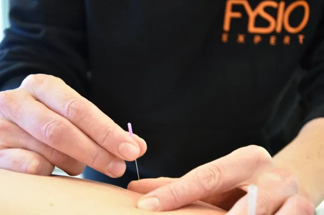 Dry Needling