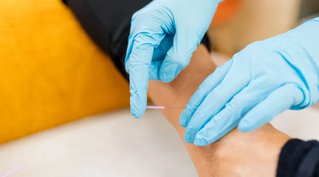Dry Needling
